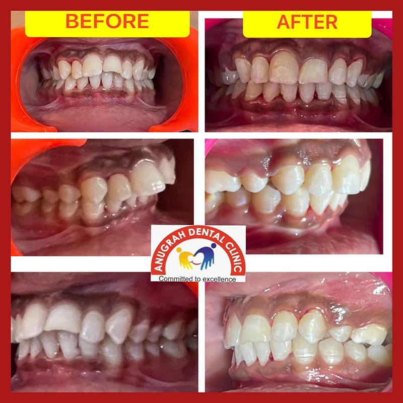 Dental implant cost in Lucknow