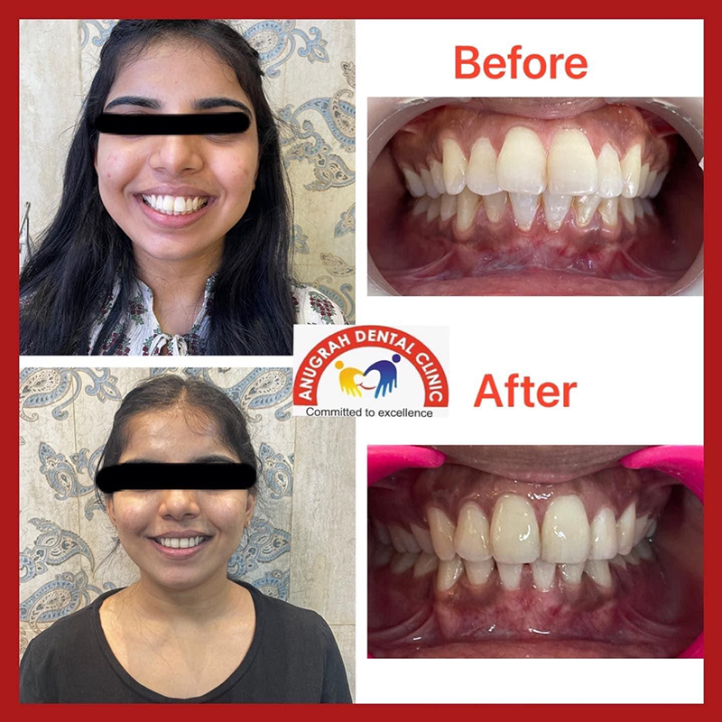 Dental package in Lucknow
