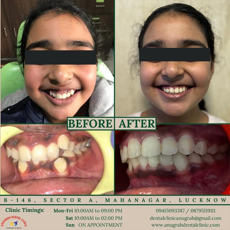 Orthodontic Treatment in Lucknow